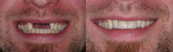 Anterior Implant replacement with Natural Aligners