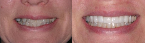 Clear Correct and Veneers