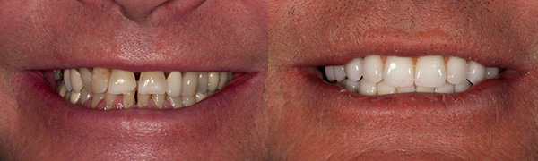 Dental Implants Before and After