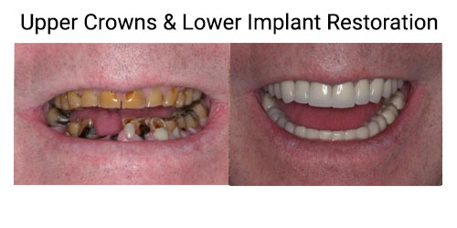 implant before