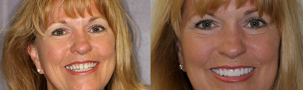 Trial Smile Before and After