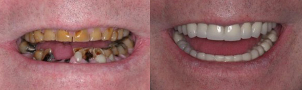 Upper Crowns and Lower Dental