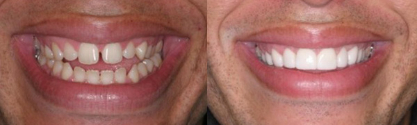 Veneers Smile Before and After