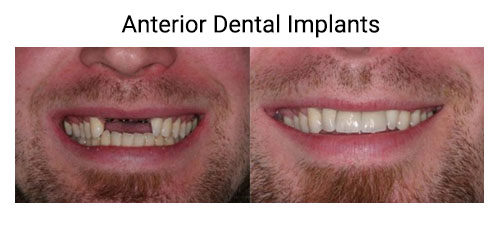 implant before after